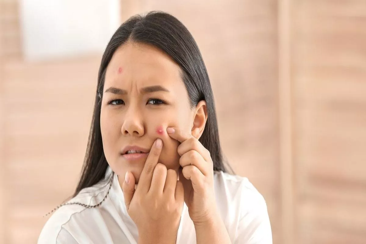 Cara Menghilangkan Jerawat Secara Cepat dengan Skincare yang Tepat