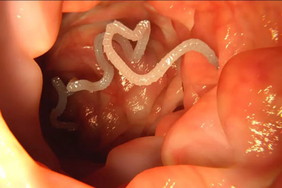 Idap Neurocysticercosis Puluhan Parasit Bersarang di Otak Wanita