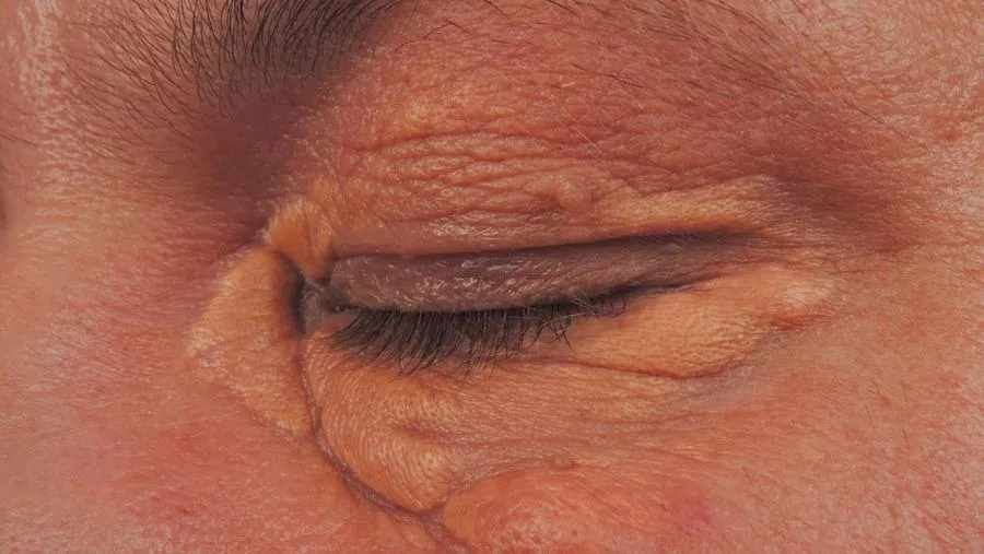 Tanda Kolesterol Tinggi yang Muncul di Mata, Perhatikan Ini!