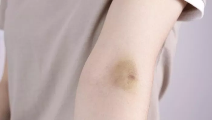 Mendadak Memar Tanpa Sebab? Segera Cek, Bisa Jadi Tanda Kena Kanker