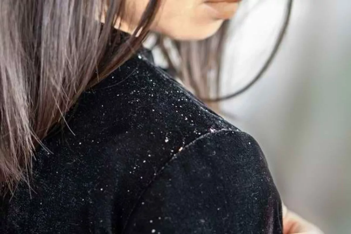 10 Cara Mengatasi Ketombe secara Alami dengan Cepat!
